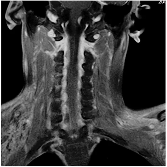 MRI Cervical Spine C Brachial Plexus Test